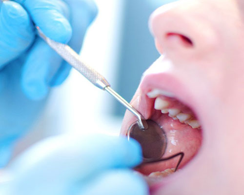 cobalt-chrome-metals-for dental-implants